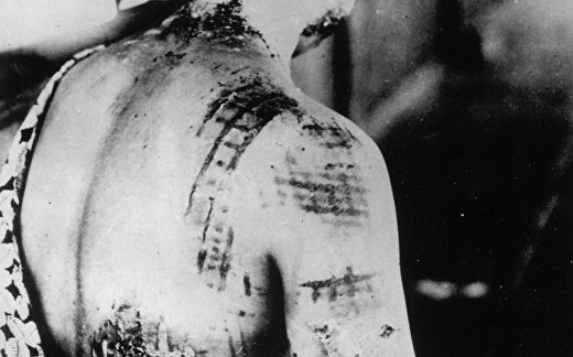 На коже женщины, пережившей бомбардировку Хиросимы, отпечатался рисунок ее кимоно